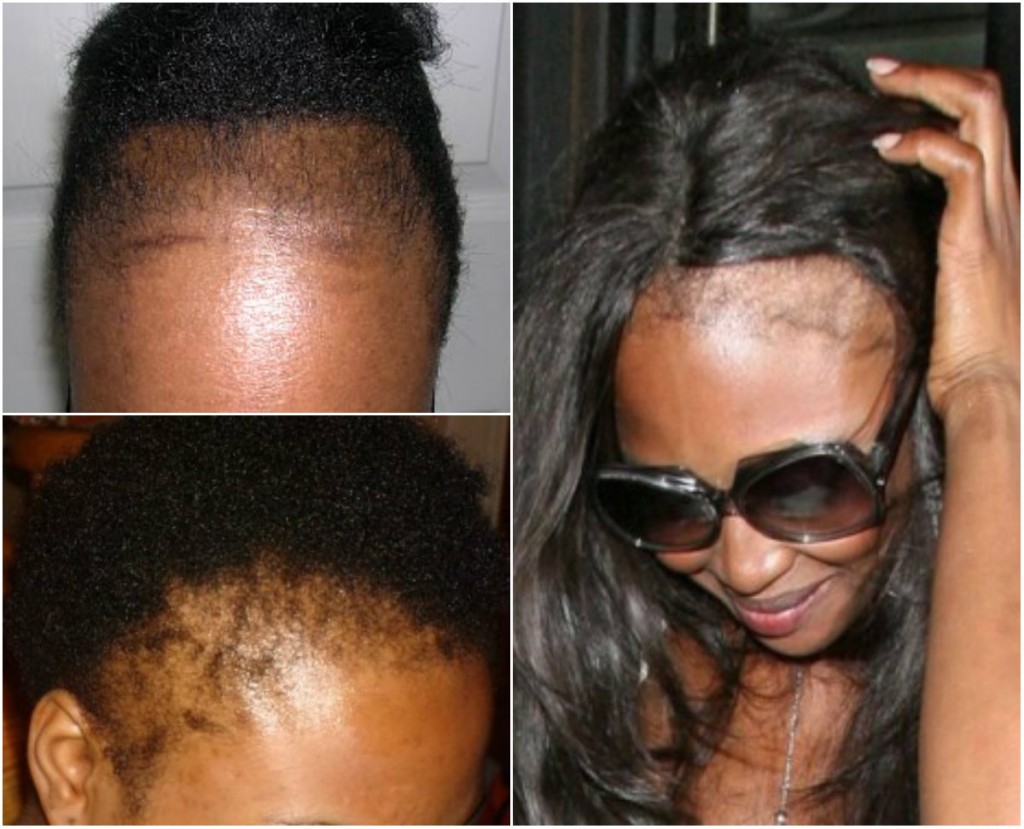 Alopecia